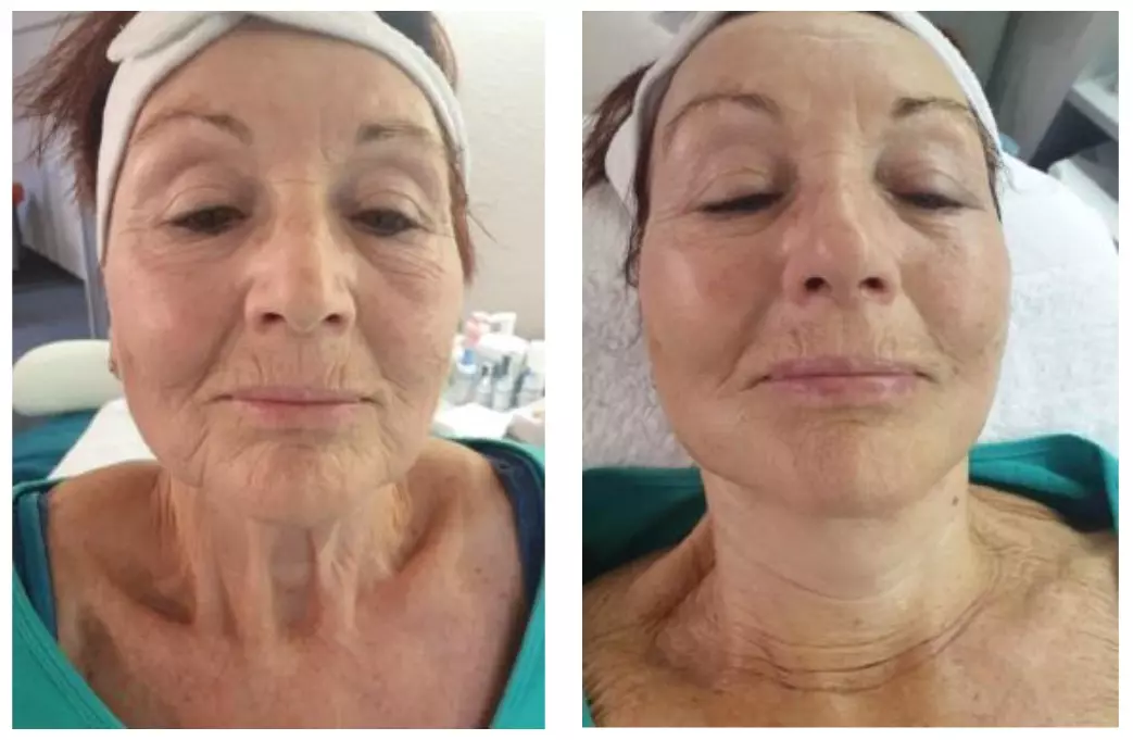 Anti-Aging Gesichtsbehandlung