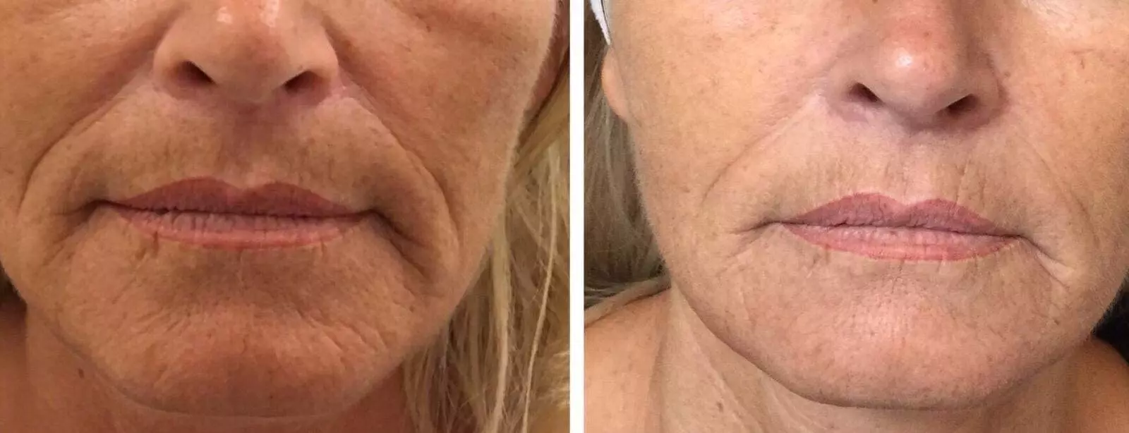 Anti-Aging Gesihtsbehandlung